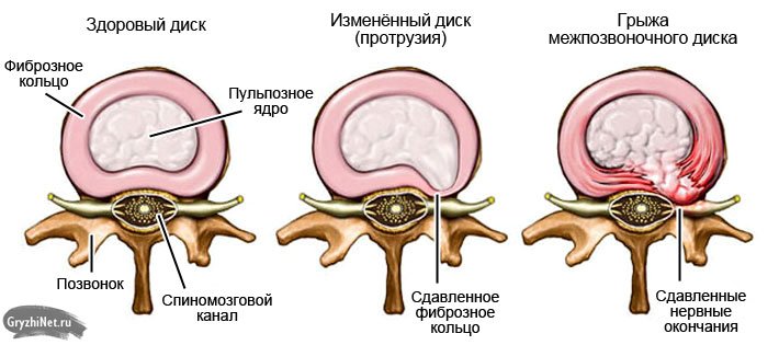 Грыжа шморля фото